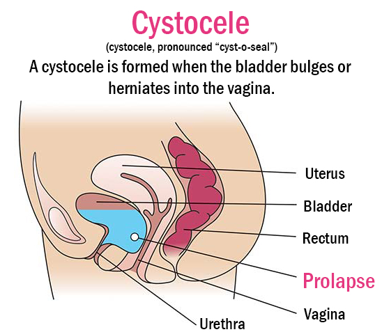 Female Pelvic Health Center - Bucks County PA Cystocele Prolapse