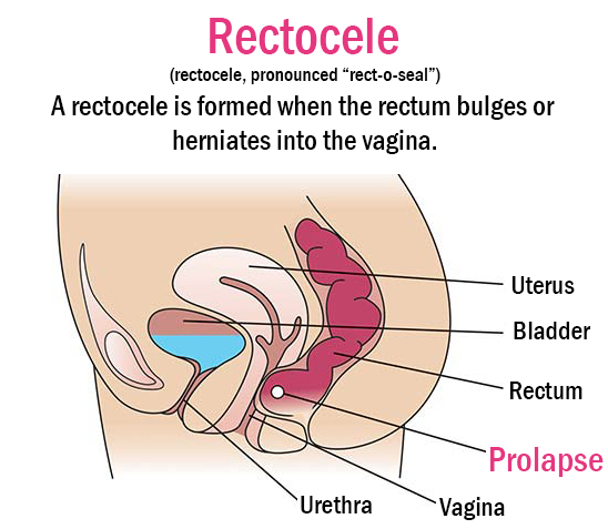 Female Pelvic Health Center - Bucks County PA Rectocele Prolapse