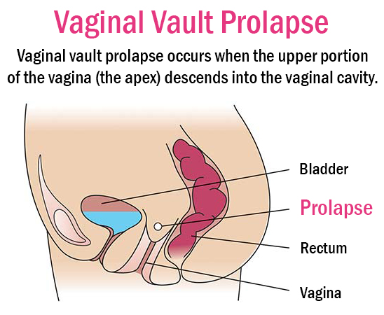 Female Pelvic Health Center - Bucks County PA Vaginal Vault Prolapse